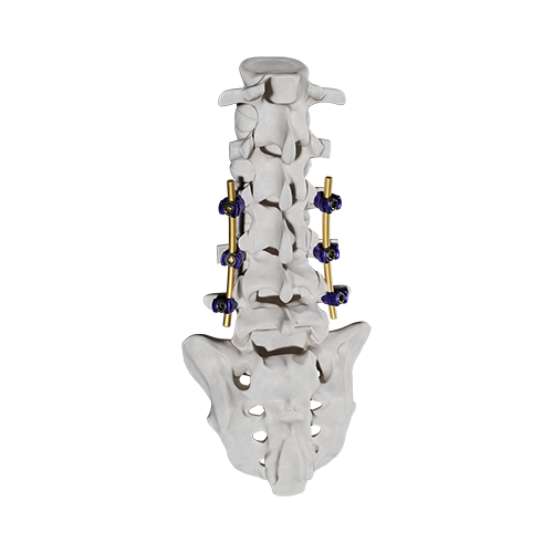 AEONEX Bone Assembly